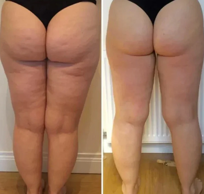 CurveLift™ Triple-Action Cellulite Remover