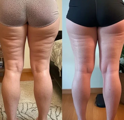 CurveLift™ Triple-Action Cellulite Remover